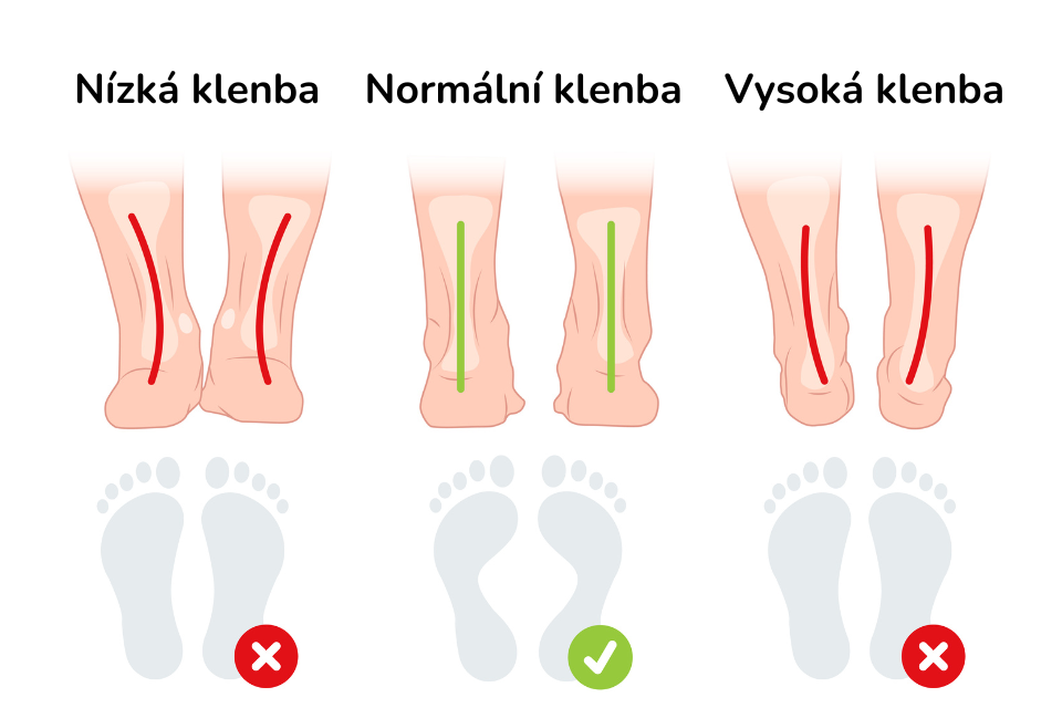 Typy chodidel - výška klenby